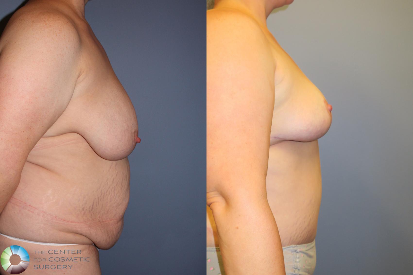 Best Denver Mommy Makeover