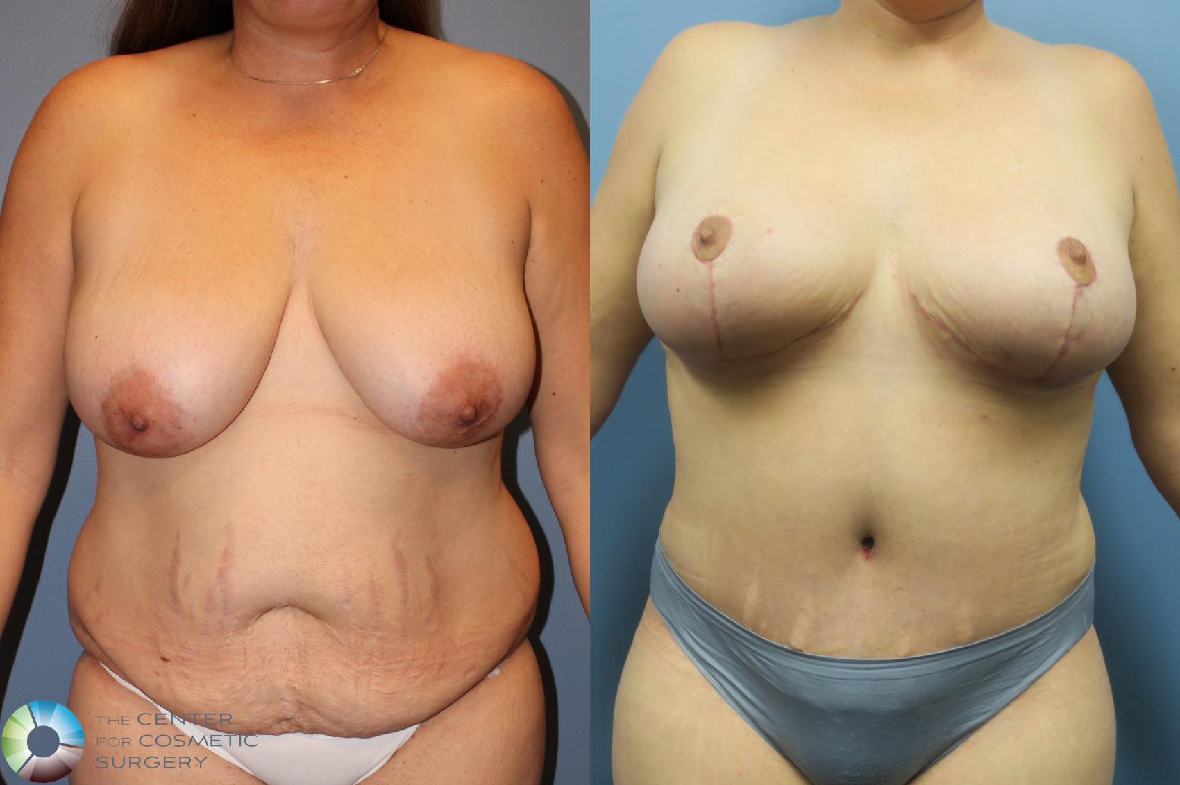 Before & After Mommy Makeover Case 11465 Front in Denver and Colorado Springs, CO