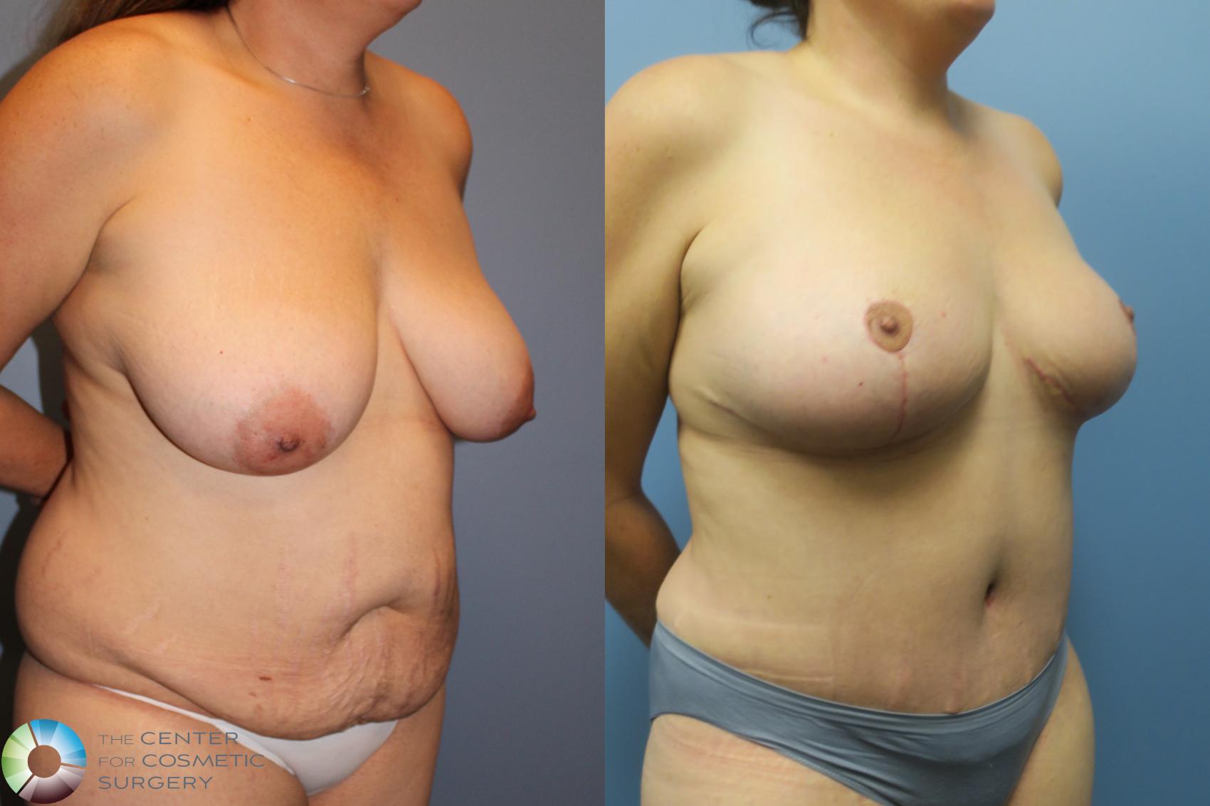 Before & After Mommy Makeover Case 11465 Right Oblique in Denver and Colorado Springs, CO