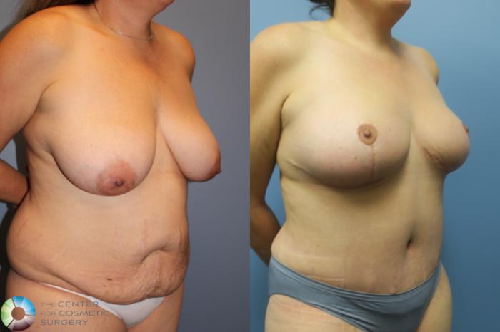 Before & After Mommy Makeover Case 11465 Right Oblique View in Golden, CO
