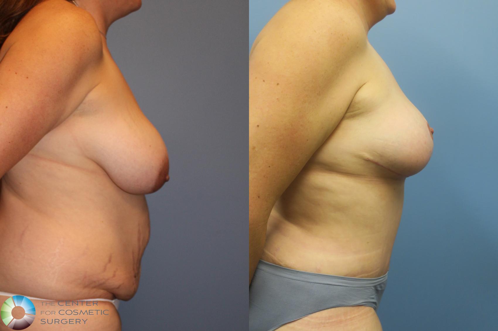 Before & After Mommy Makeover Case 11465 Right Side View in Golden, CO
