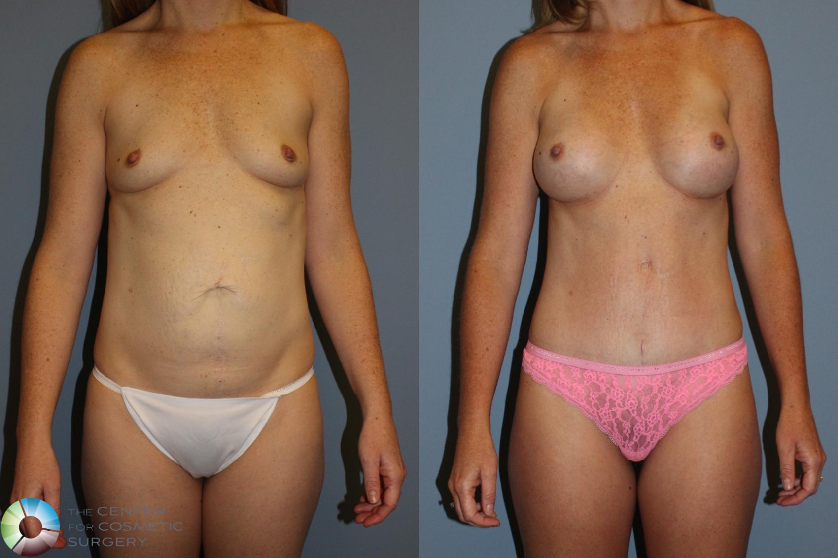 Before & After Mommy Makeover Case 11492 Front in Denver and Colorado Springs, CO