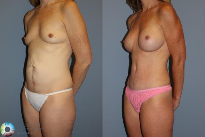 Before & After Mommy Makeover Case 11492 Left Oblique View in Golden, CO