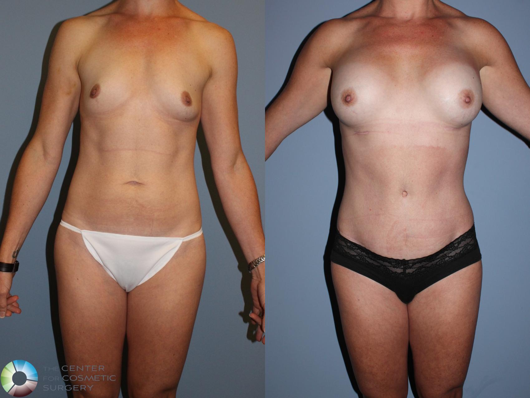 Before & After Mommy Makeover Case 11498 Front in Denver and Colorado Springs, CO