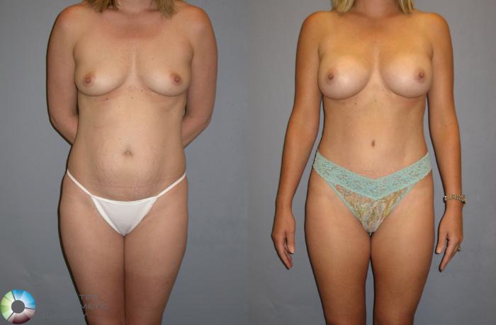 Before & After Tummy Tuck Case 115 View #1 in Denver and Colorado Springs, CO