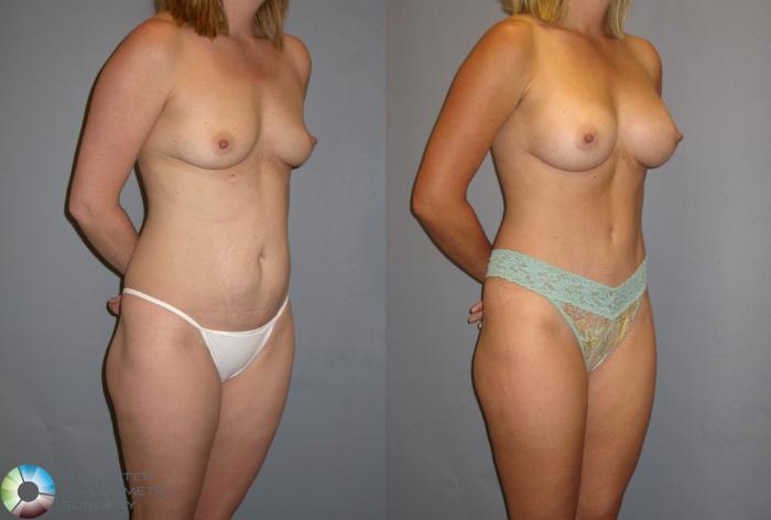 Before & After Breast Augmentation Case 115 View #2 in Denver and Colorado Springs, CO