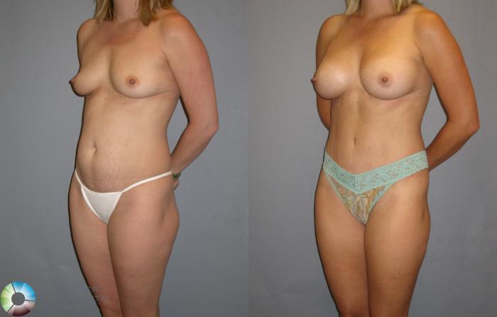 Before & After Breast Augmentation Case 115 View #3 in Denver and Colorado Springs, CO