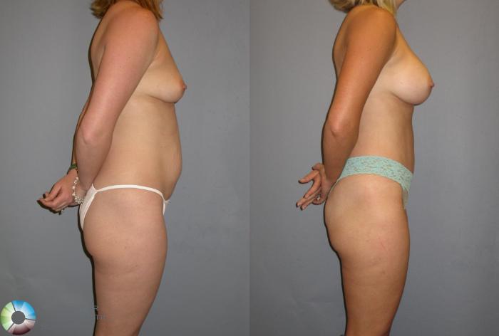 Before & After Tummy Tuck Case 115 View #4 in Denver and Colorado Springs, CO