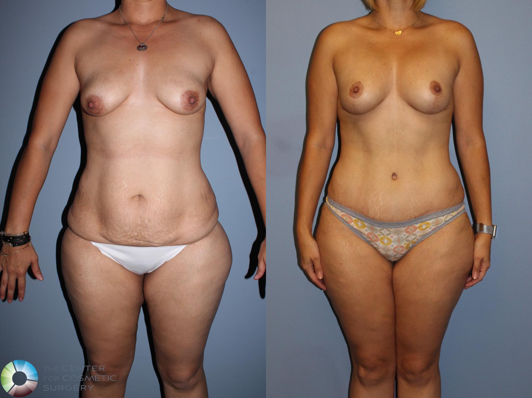 Before & After Breast Lift Case 11512 Front in Denver and Colorado Springs, CO