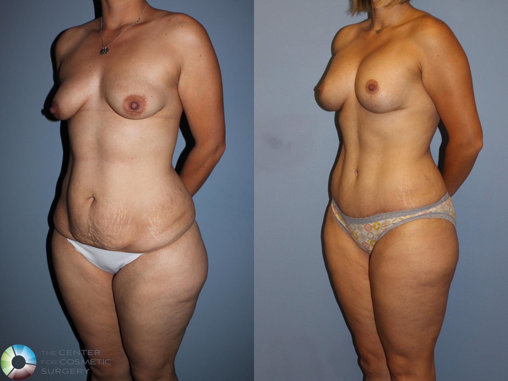 Before & After Mommy Makeover Case 11512 Left Oblique View in Golden, CO
