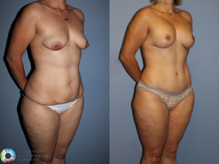 Before & After Mommy Makeover Case 11512 Right Oblique View in Golden, CO