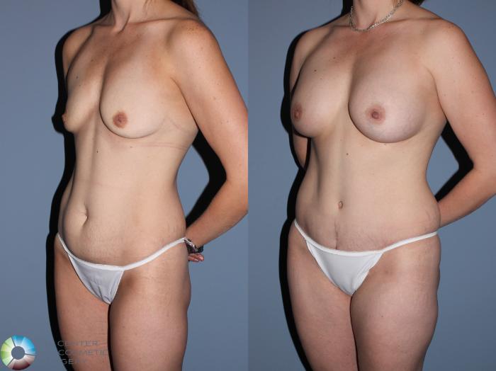 Before & After Mommy Makeover Case 11558 Left Oblique View in Golden, CO