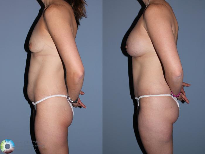 Before & After Mommy Makeover Case 11558 Left Side View in Golden, CO