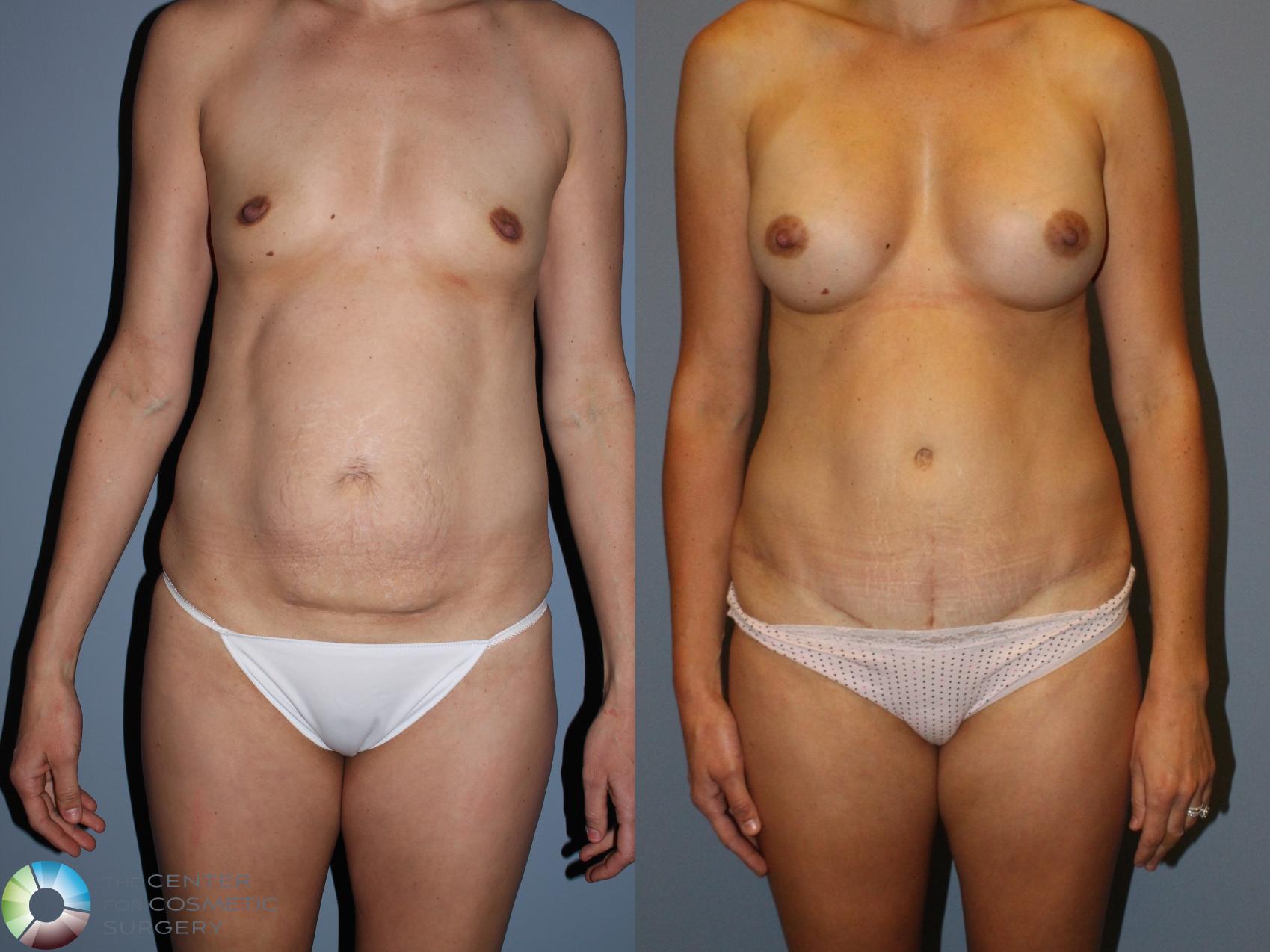 Before & After Mommy Makeover Case 11596 Front in Denver and Colorado Springs, CO