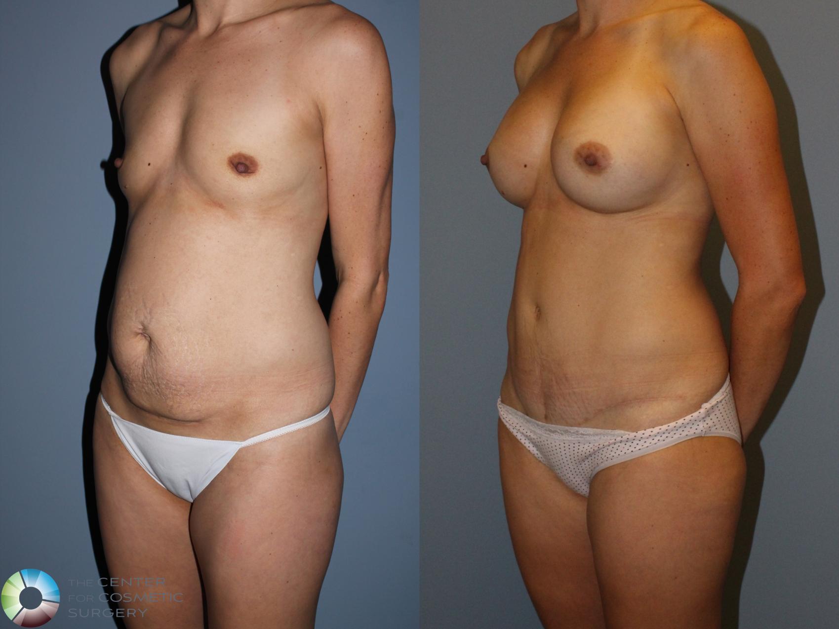 Before & After Mommy Makeover Case 11596 Left Oblique View in Golden, CO
