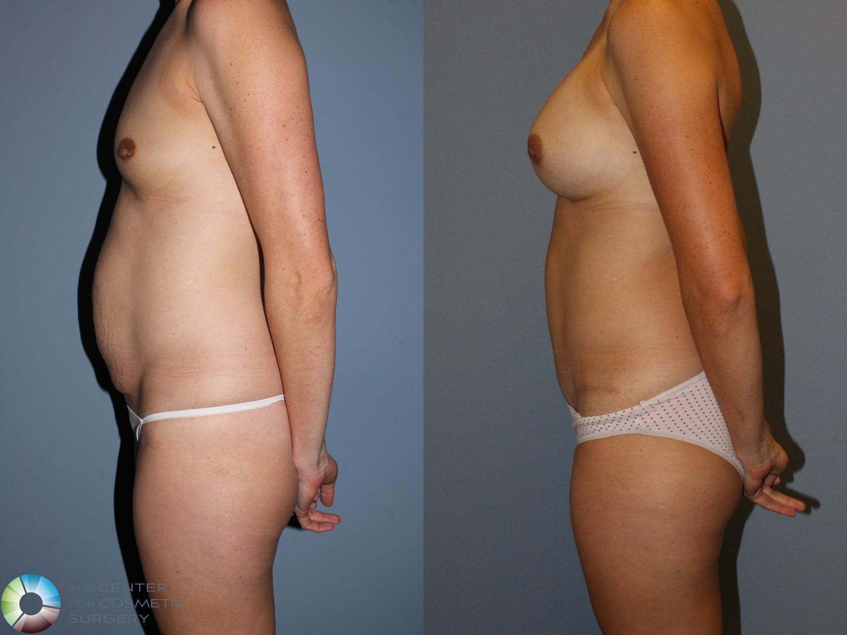 Before & After Mommy Makeover Case 11596 Left Side in Denver and Colorado Springs, CO