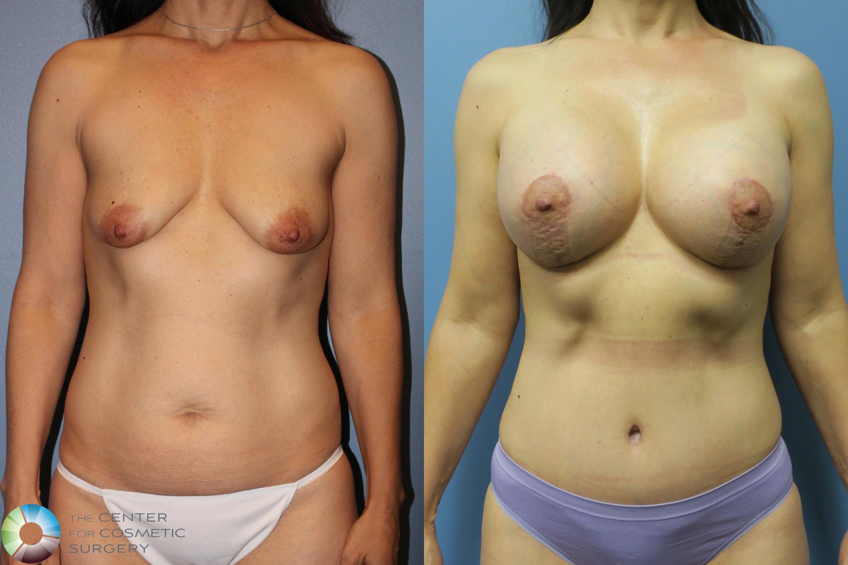 Before & After Mommy Makeover Case 11609 Front in Denver and Colorado Springs, CO