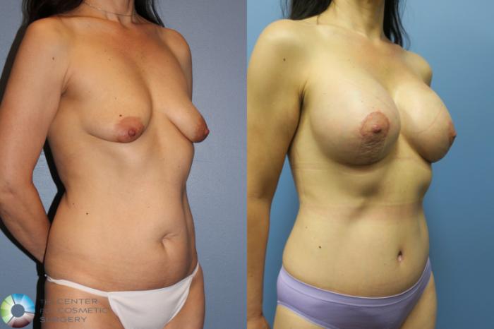 Before & After Mommy Makeover Case 11609 Right Oblique View in Golden, CO