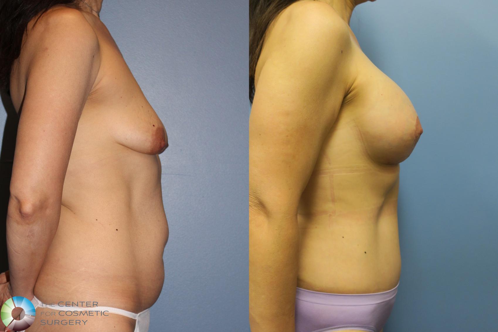 Before & After Mommy Makeover Case 11609 Right Side in Denver and Colorado Springs, CO