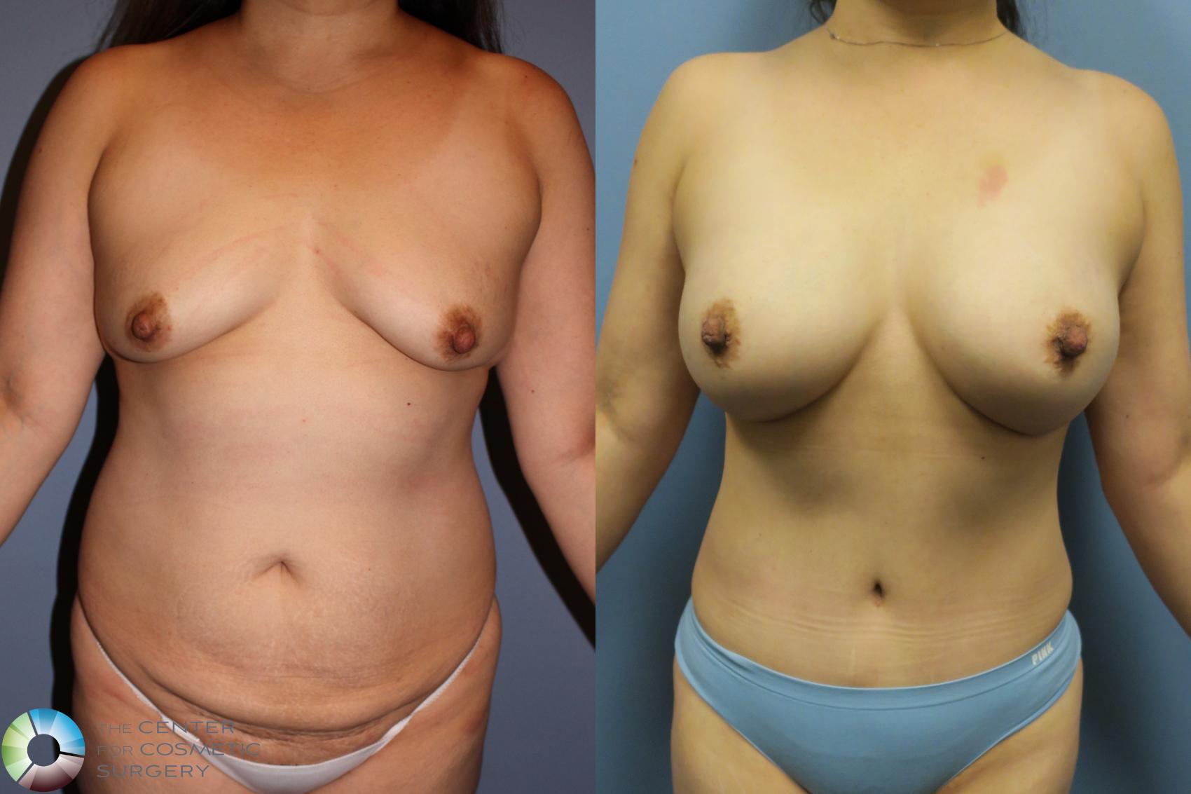 Before & After Tummy Tuck Case 11611 Front in Denver and Colorado Springs, CO