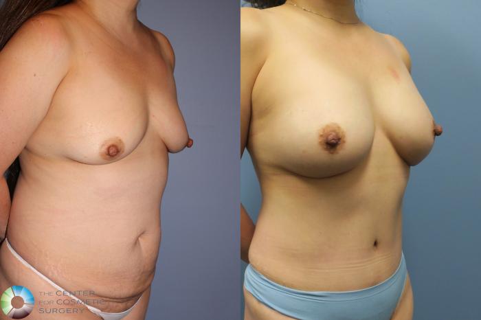 Before & After Mommy Makeover Case 11611 Right Oblique View in Golden, CO
