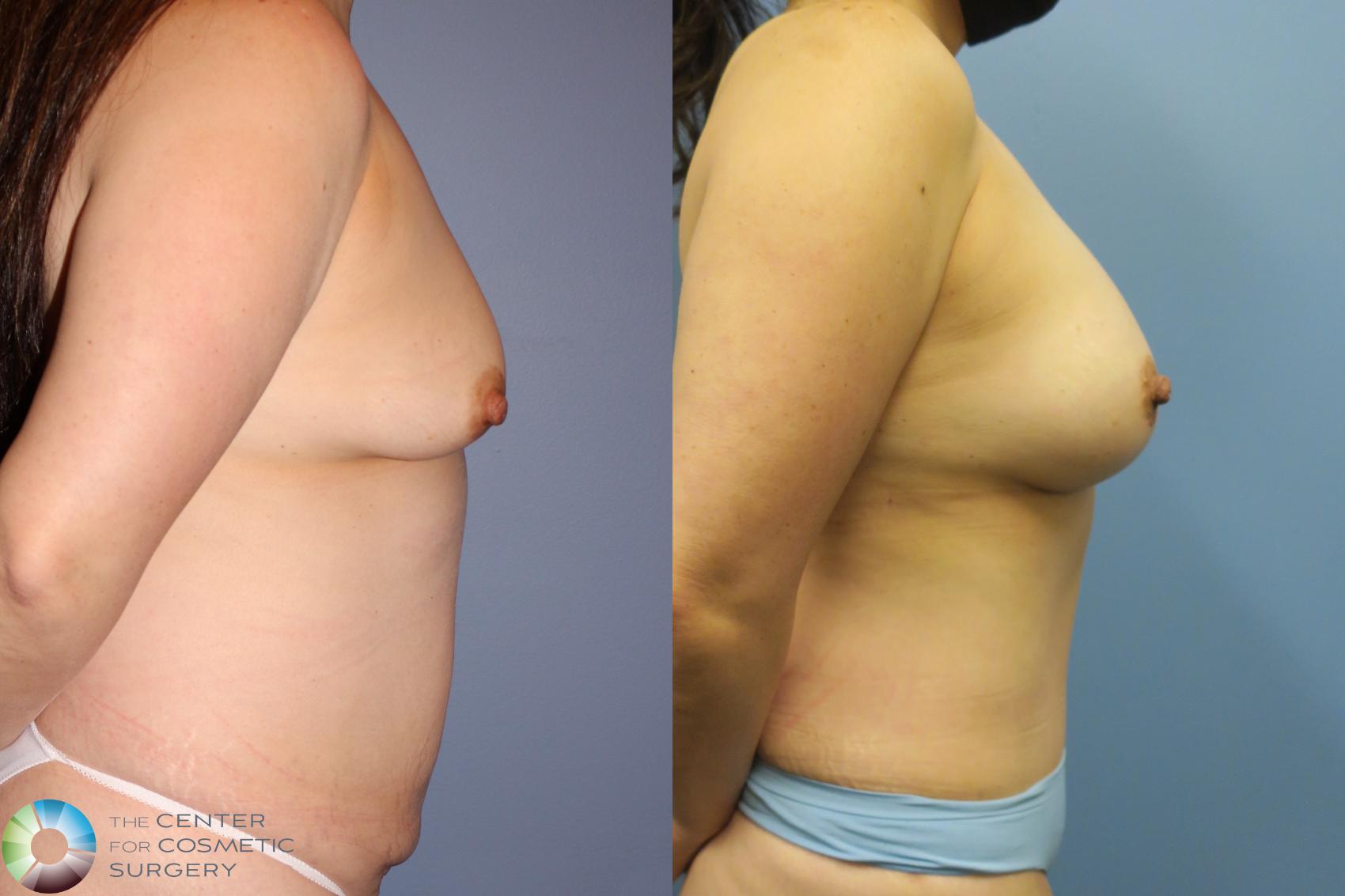 Before & After Mommy Makeover Case 11611 Right Side in Denver and Colorado Springs, CO