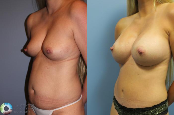 Before & After Mommy Makeover Case 11632 Left Oblique View in Golden, CO