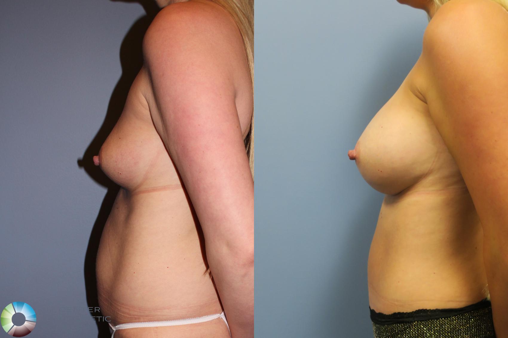 Best Denver Mommy Makeover