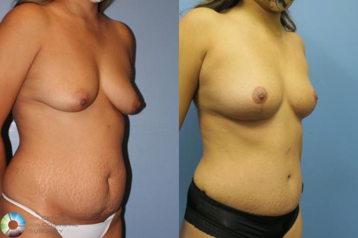 Before & After Mommy Makeover Case 11634 Right Oblique in Denver and Colorado Springs, CO