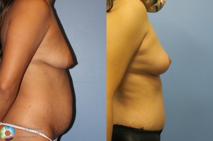 Before & After Mommy Makeover Case 11634 Right Side in Denver and Colorado Springs, CO