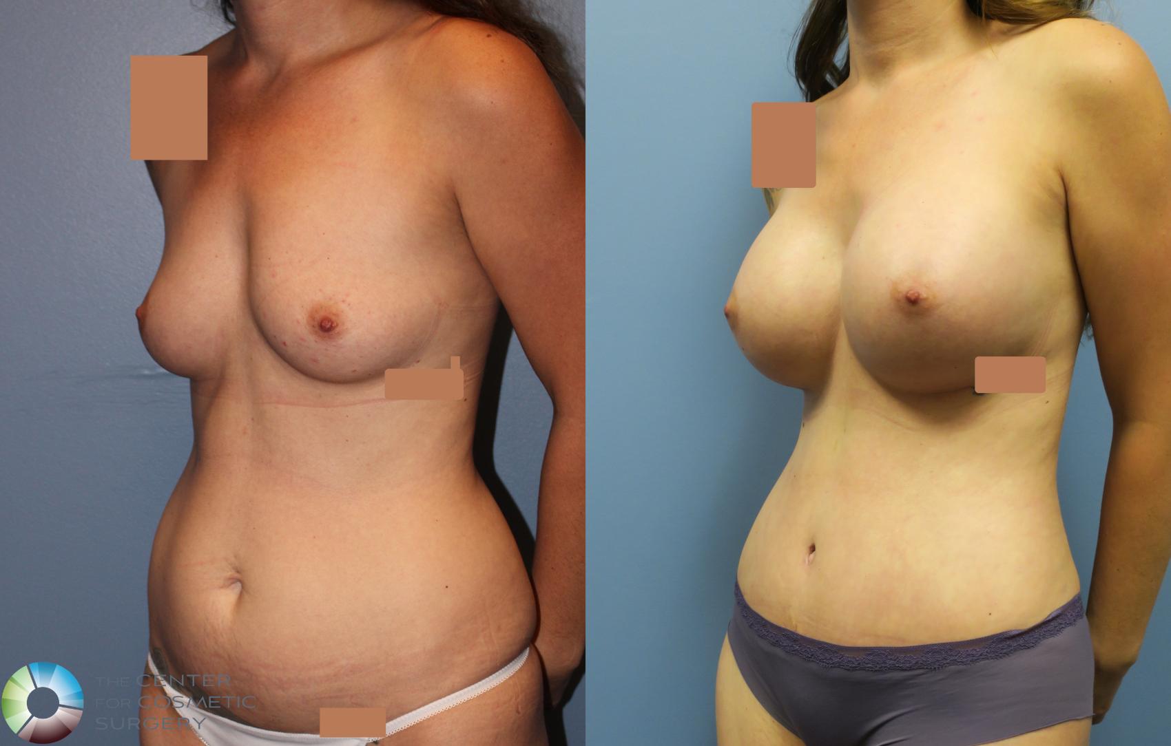 Before & After Mommy Makeover Case 11641 Left Oblique in Denver and Colorado Springs, CO