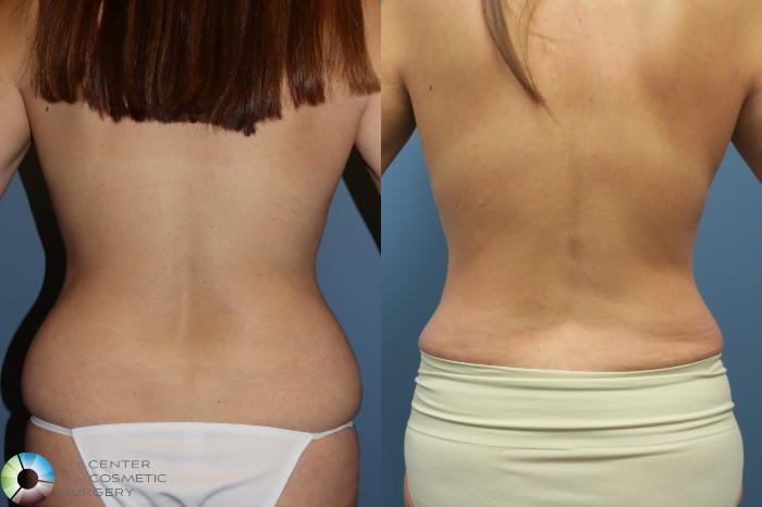Before & After Mommy Makeover Case 11737 Back in Denver and Colorado Springs, CO