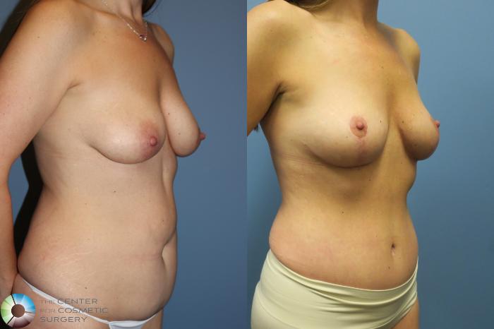 Before & After Mommy Makeover Case 11737 Right Oblique in Denver and Colorado Springs, CO