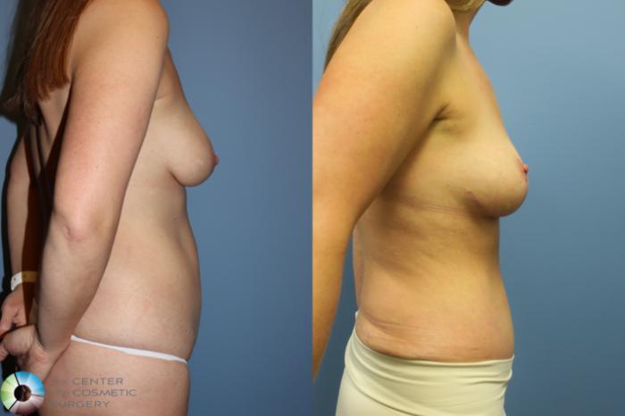 Before & After Mommy Makeover Case 11737 Right Side in Denver and Colorado Springs, CO
