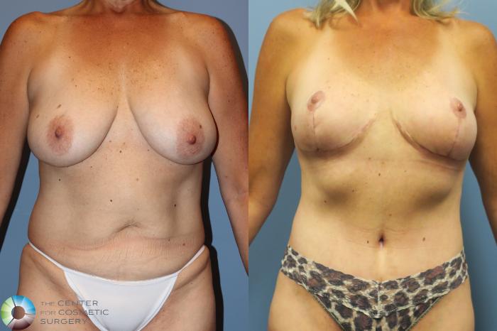 Before & After Mommy Makeover Case 11738 Front in Denver and Colorado Springs, CO