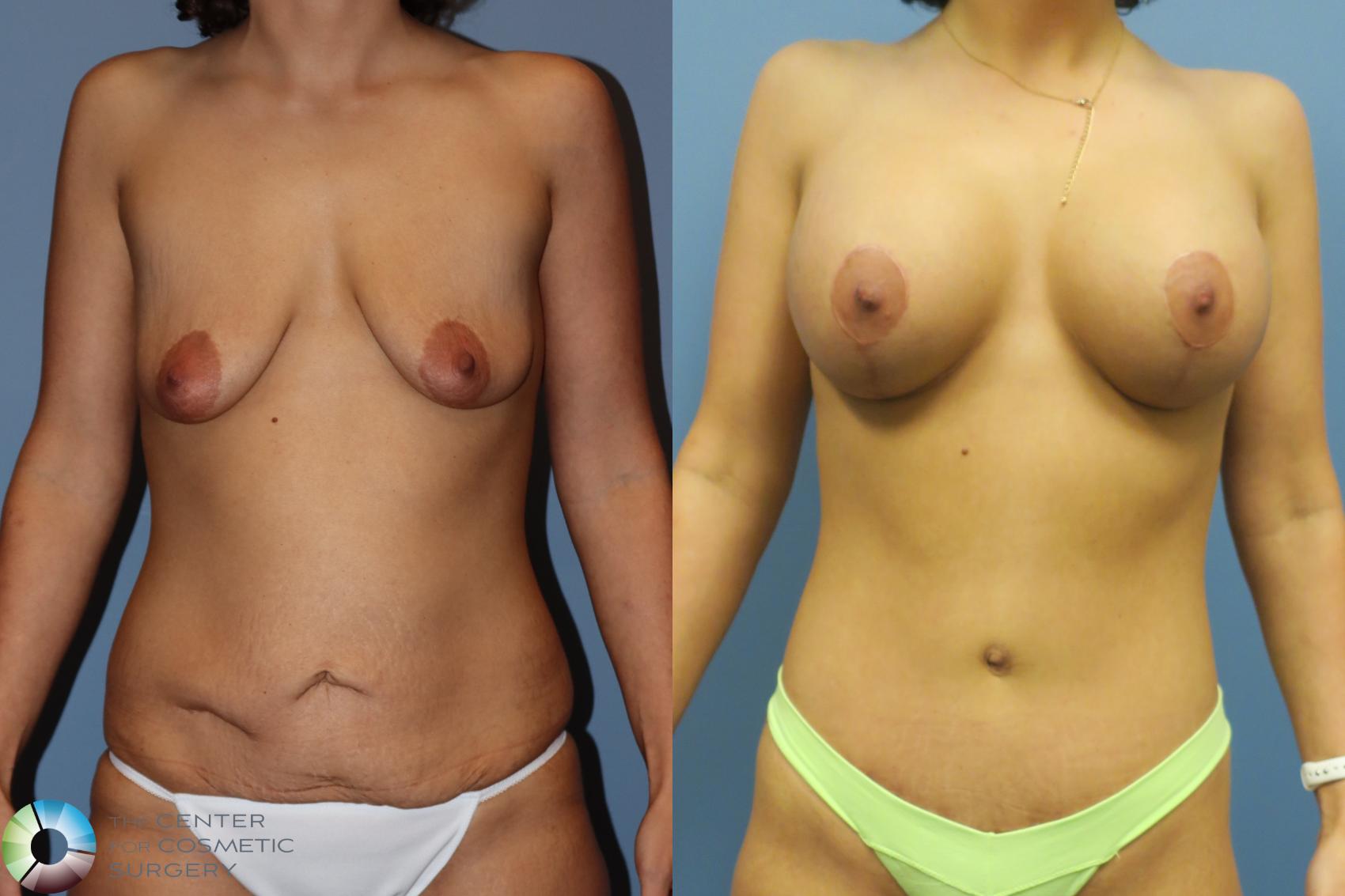 Before & After Mommy Makeover Case 11739 Front in Denver and Colorado Springs, CO