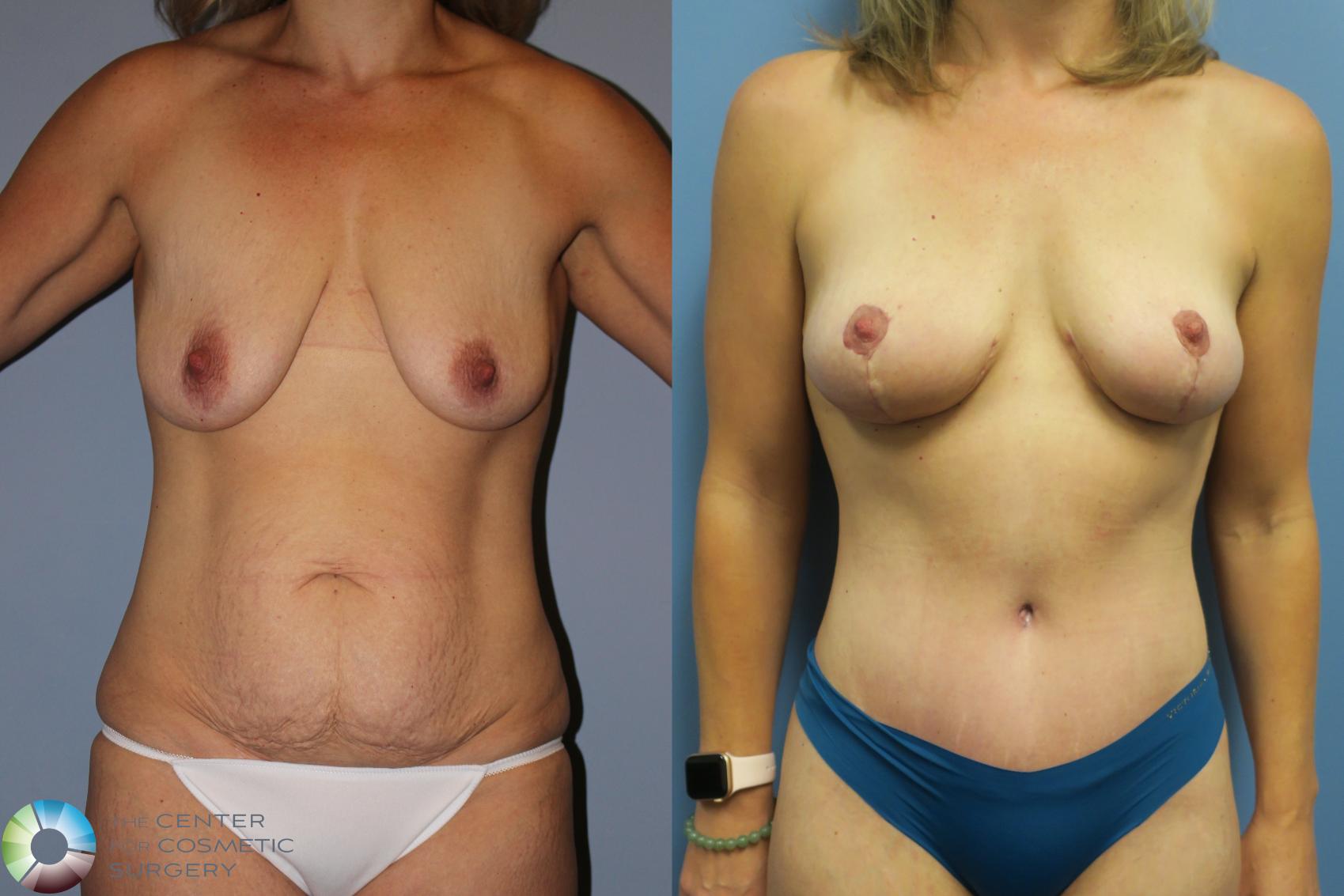 Before & After Mommy Makeover Case 11849 Front in Denver and Colorado Springs, CO