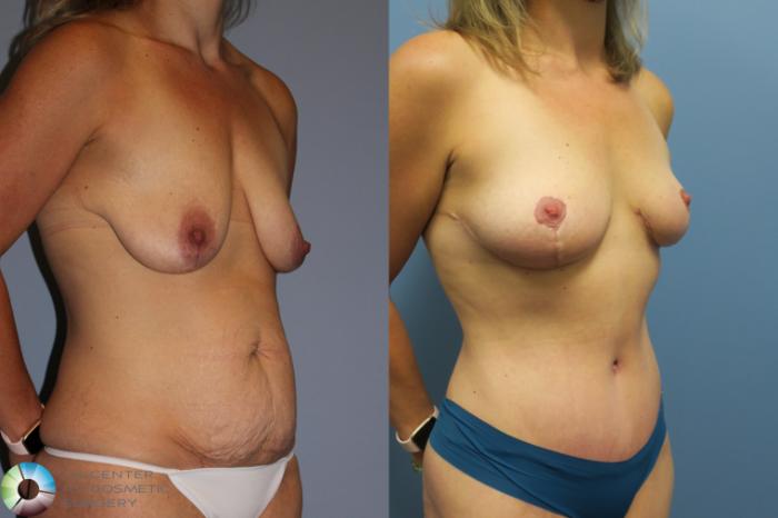 Before & After Mommy Makeover Case 11849 Right Oblique View in Golden, CO