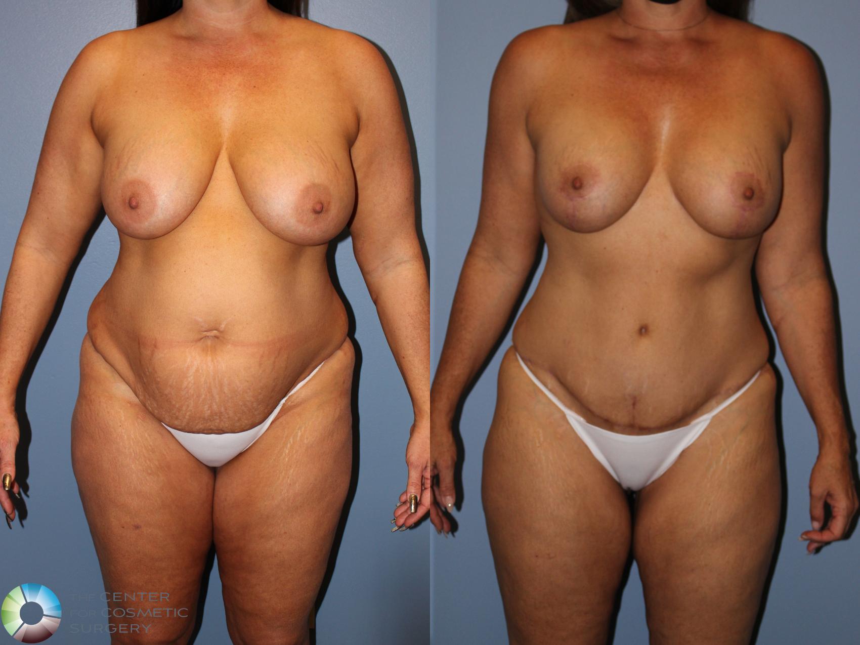 Before & After Mommy Makeover Case 11878 Front View in Golden, CO