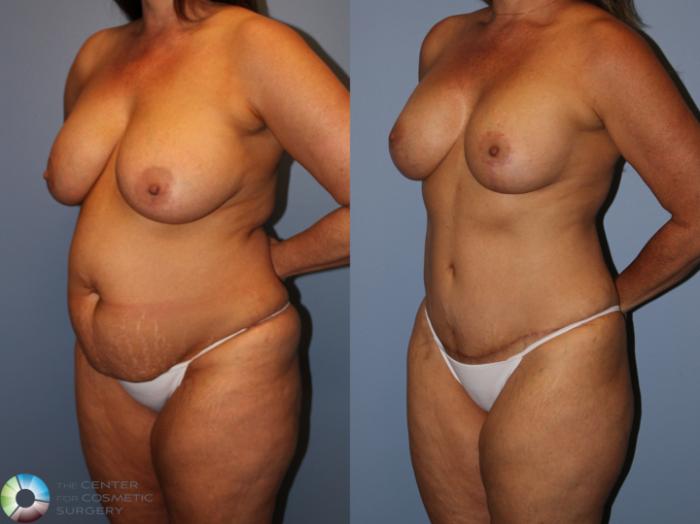 Before & After Mommy Makeover Case 11878 Right Oblique View in Golden, CO