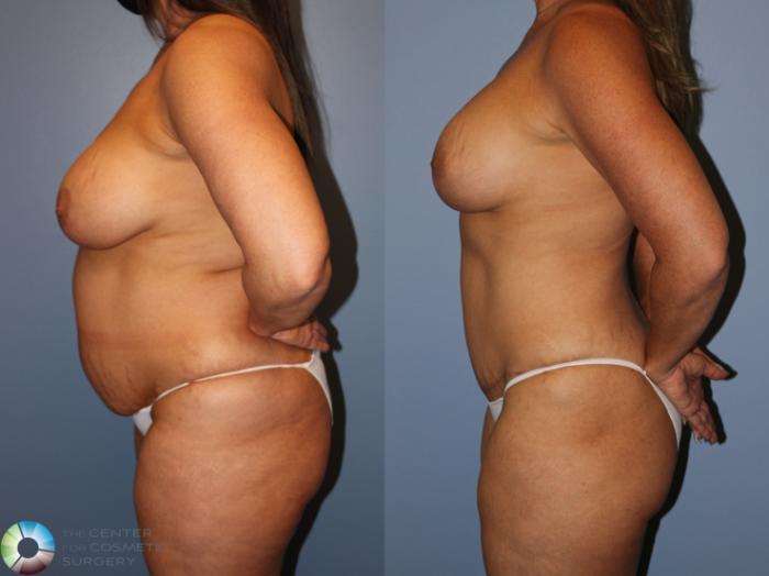 Before & After Mommy Makeover Case 11878 Right Side View in Golden, CO