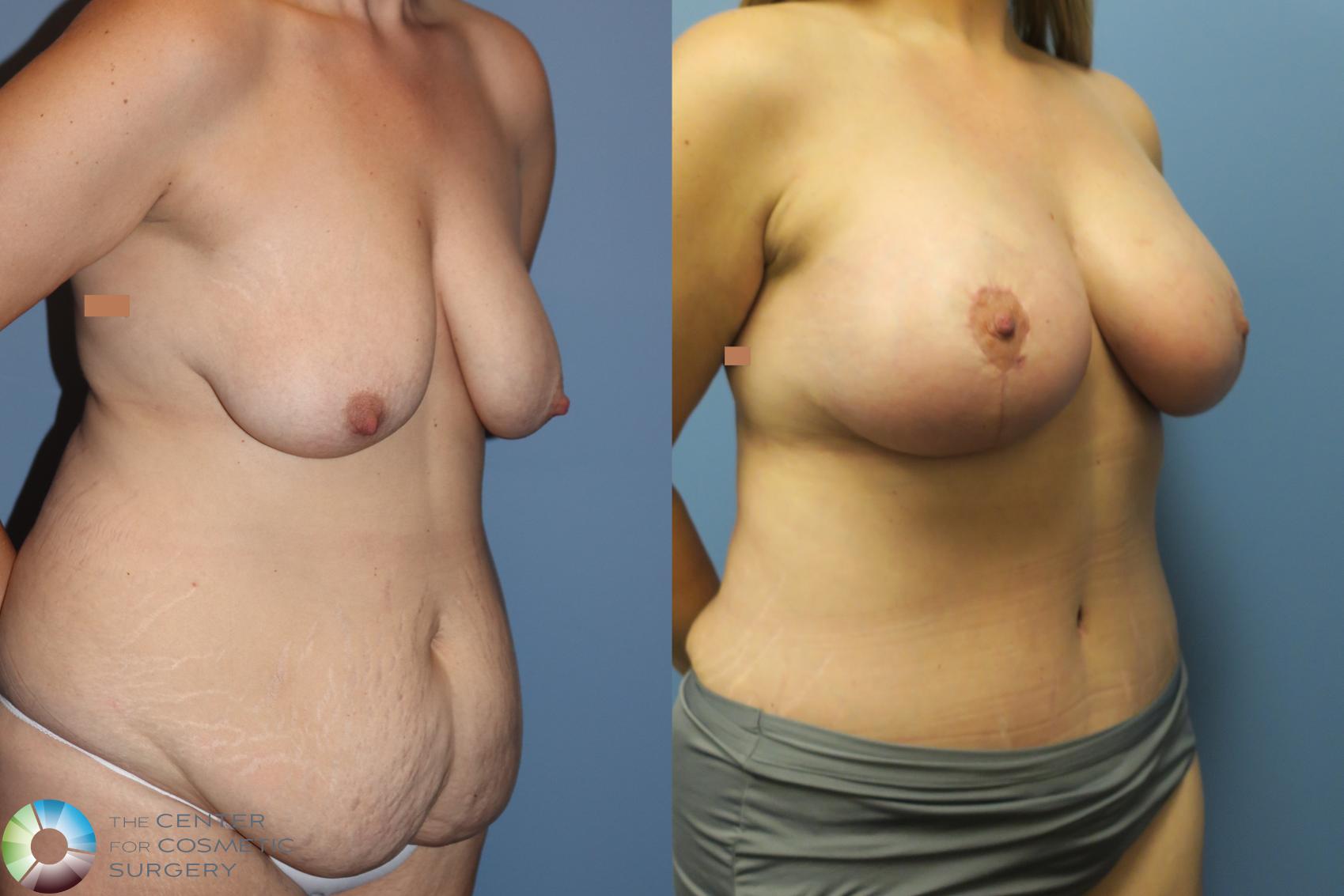 Before & After Mommy Makeover Case 11894 Right Oblique in Denver and Colorado Springs, CO