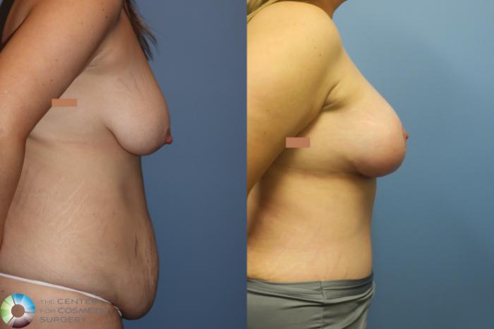 Before & After Mommy Makeover Case 11894 Right Side in Denver and Colorado Springs, CO