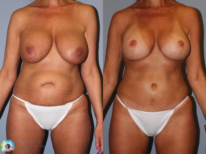 Before & After Mommy Makeover Case 11898 Front View in Golden, CO
