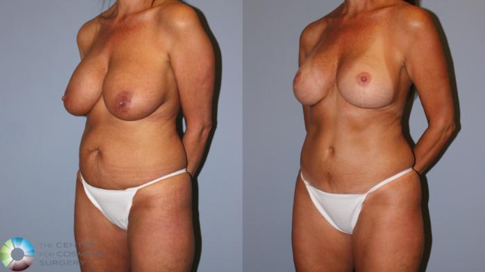 Before & After Mommy Makeover Case 11898 Left Oblique View in Golden, CO