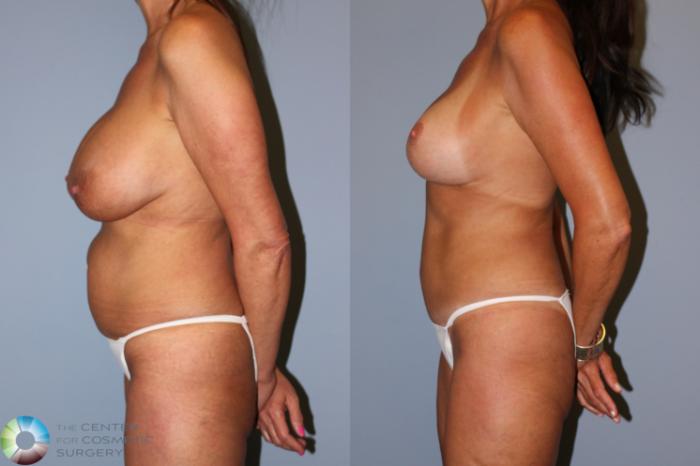 Before & After Mommy Makeover Case 11898 Left Side View in Golden, CO