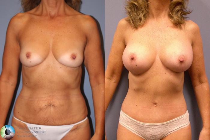 Before & After Mommy Makeover Case 11933 Front in Denver and Colorado Springs, CO