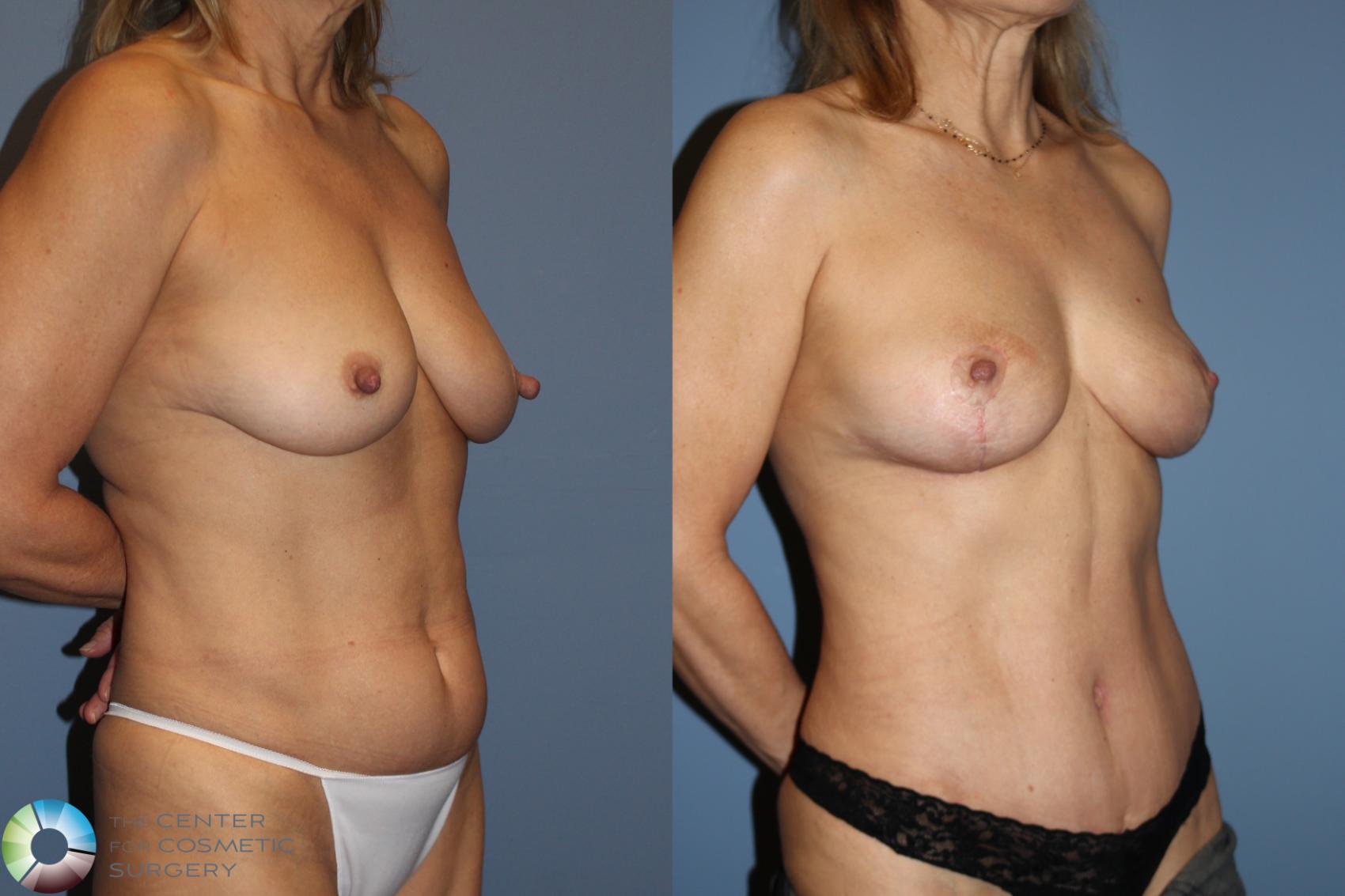 Before & After Mommy Makeover Case 11934 Right Oblique View in Golden, CO