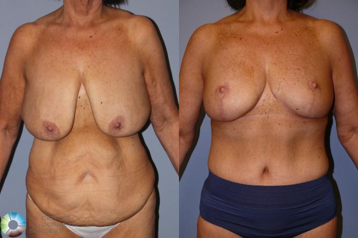 Before & After Mommy Makeover Case 11936 Front in Denver and Colorado Springs, CO