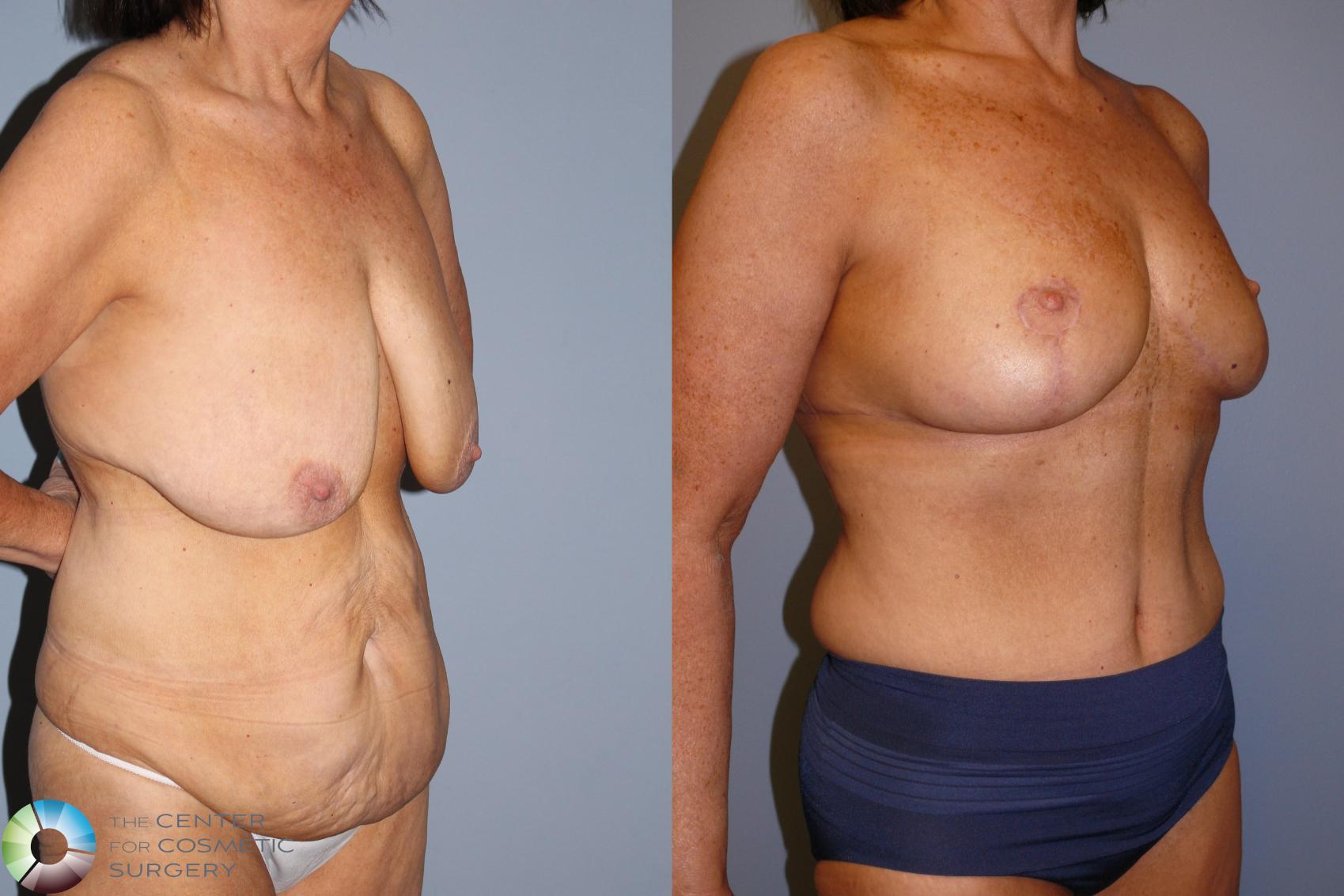Before & After Mommy Makeover Case 11936 Right Oblique in Denver and Colorado Springs, CO